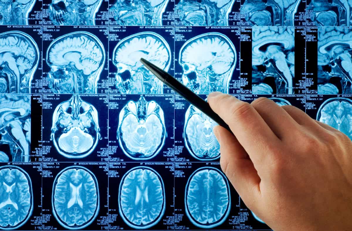brain scan, brain image, autism